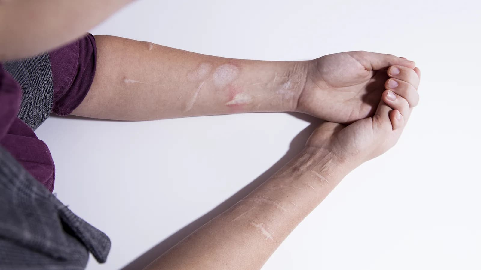 Close-up of forearms with healed self-harm scars for a parent guide about teen self-harm