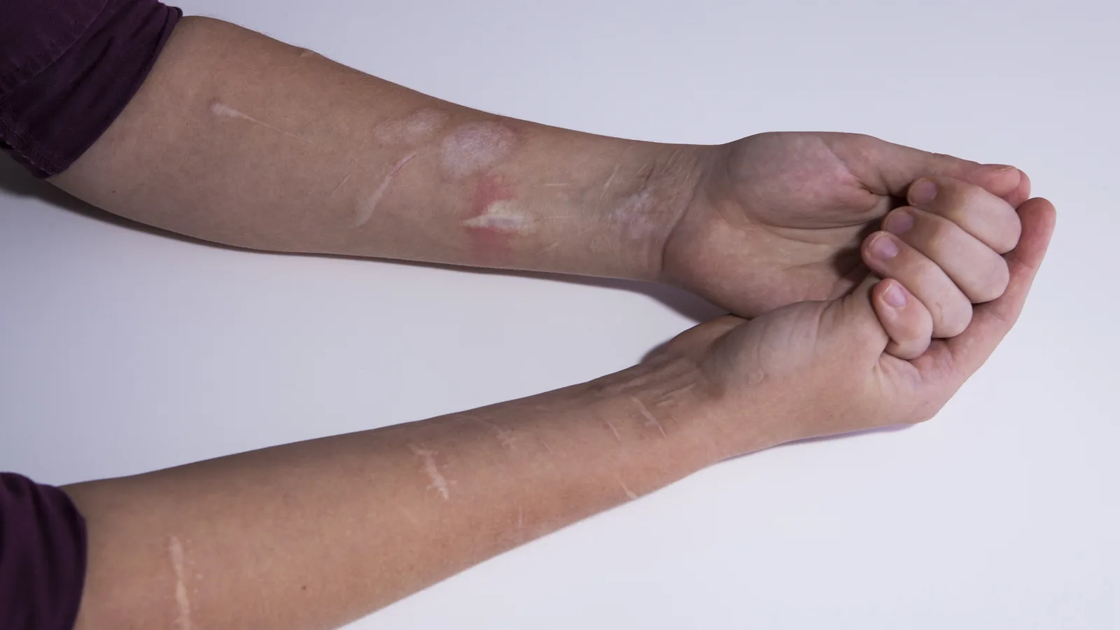 Close-up of a forearm with healed self-harm marks for a teen self-harm safety article